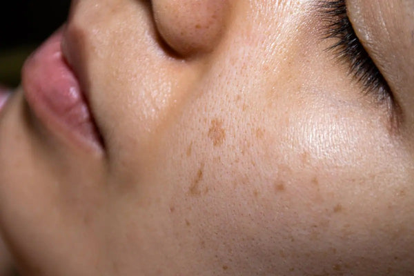 Dullness & Dark Spots